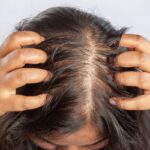 Remedios caseros para alopecia alopecia, remedios caseros, QuéOnnda
