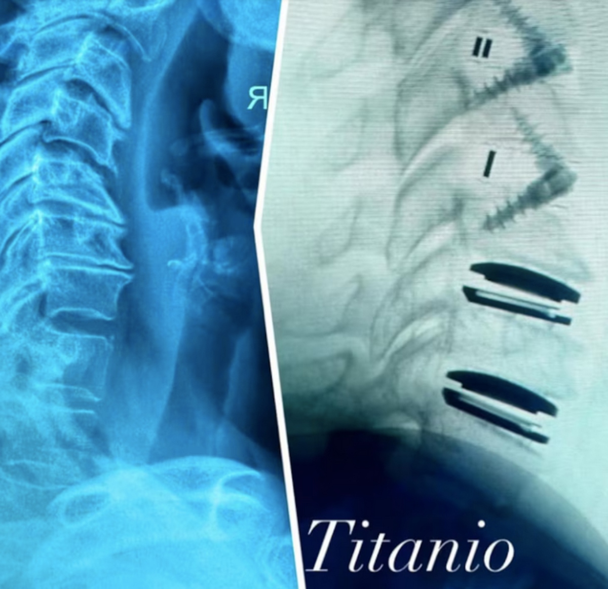 Alejandra Guzmán accidente con su cadera